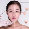 盘锦假体隆鼻价格|张宏欣医疗美容诊所专业的整形美容推荐