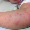 如何治疗湿疹技术强不强-口碑好的保山润华湿疹治疗推荐