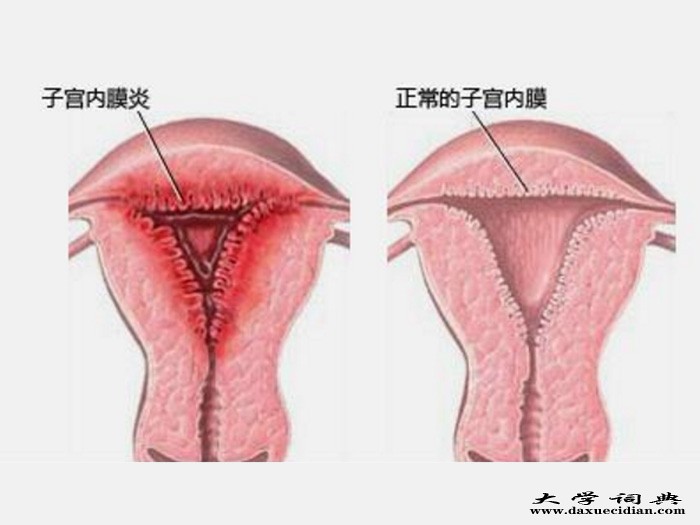 输卵管阻塞不孕