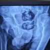 高密股骨头置换医院-治疗股骨头坏死费用如何