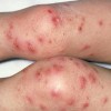如何治疗湿疹哪里能治疗|云南可信赖的保山润华湿疹治疗
