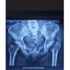 治疗股骨头坏死医院-山东具有口碑的治疗股骨头坏死机构