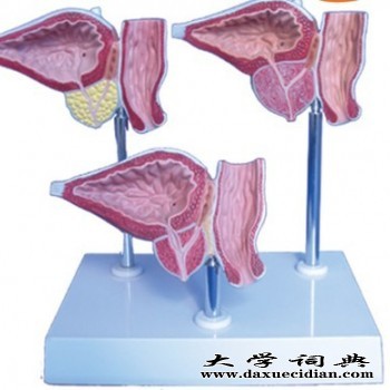KAY-0659前列腺病态模型-上海康谊医学模型厂家图1